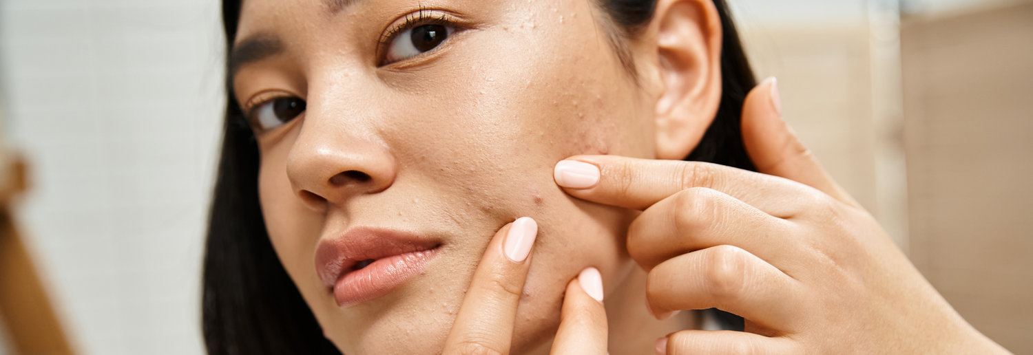 Pimplepedia: All You Need to Know About Acne