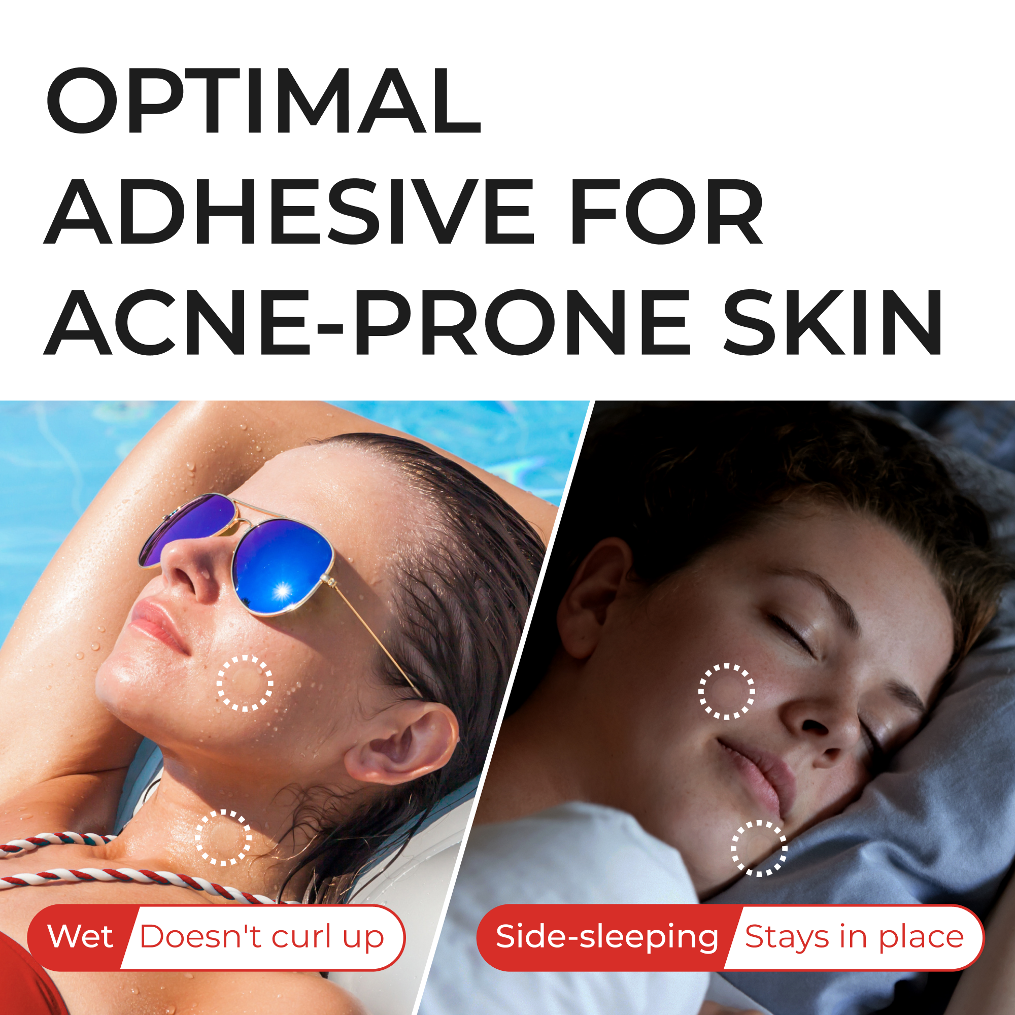 optimal adhesive for acne-prone skin